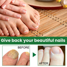 Load image into Gallery viewer, 20ml Onychomycosis Liquid Onychomycosis Care Repair Liquid Nail Feet Onychomycosis Liquid Nail Care Liquid Health Care
