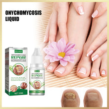 Load image into Gallery viewer, 20ml Onychomycosis Liquid Onychomycosis Care Repair Liquid Nail Feet Onychomycosis Liquid Nail Care Liquid Health Care
