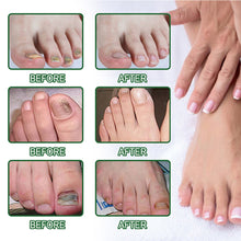 Load image into Gallery viewer, 20ml Onychomycosis Liquid Onychomycosis Care Repair Liquid Nail Feet Onychomycosis Liquid Nail Care Liquid Health Care
