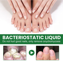 Load image into Gallery viewer, 20ml Onychomycosis Liquid Onychomycosis Care Repair Liquid Nail Feet Onychomycosis Liquid Nail Care Liquid Health Care
