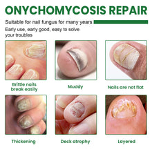 Load image into Gallery viewer, 20ml Onychomycosis Liquid Onychomycosis Care Repair Liquid Nail Feet Onychomycosis Liquid Nail Care Liquid Health Care
