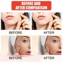 Load image into Gallery viewer, Hydrocolloid Acne Patch Waterproof Breathable Invisible Acne Patch Pimple Remover Patch Skin Care Repair

