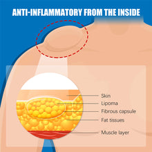 Load image into Gallery viewer, Lipoma Cream Reduce Inflammation Remove Lipomas Fibromas Subcutaneous Masses Body Care Cream Health Care
